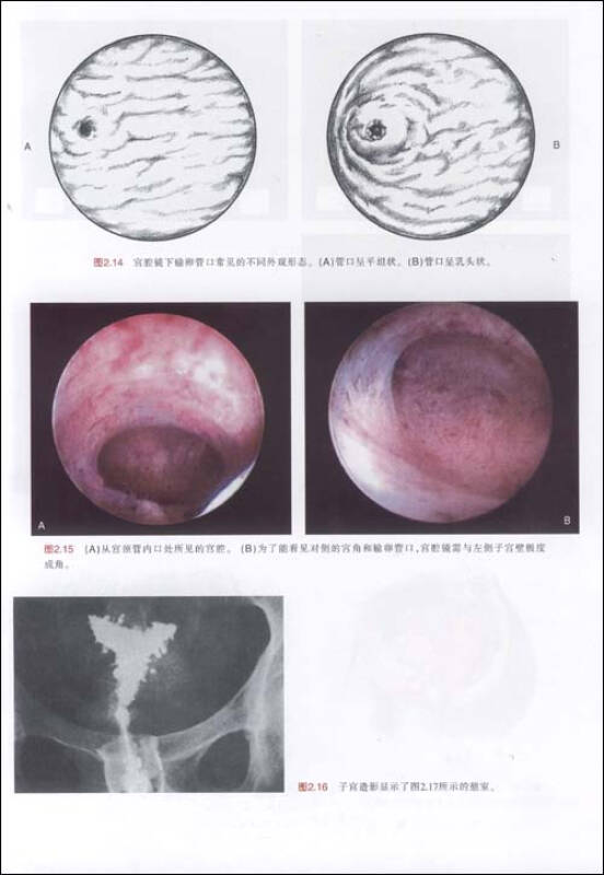 宫腔镜诊断及手术:解剖,生理,病理学图解
