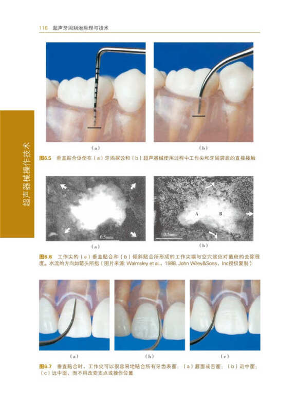 超声牙周刮治原理与技术