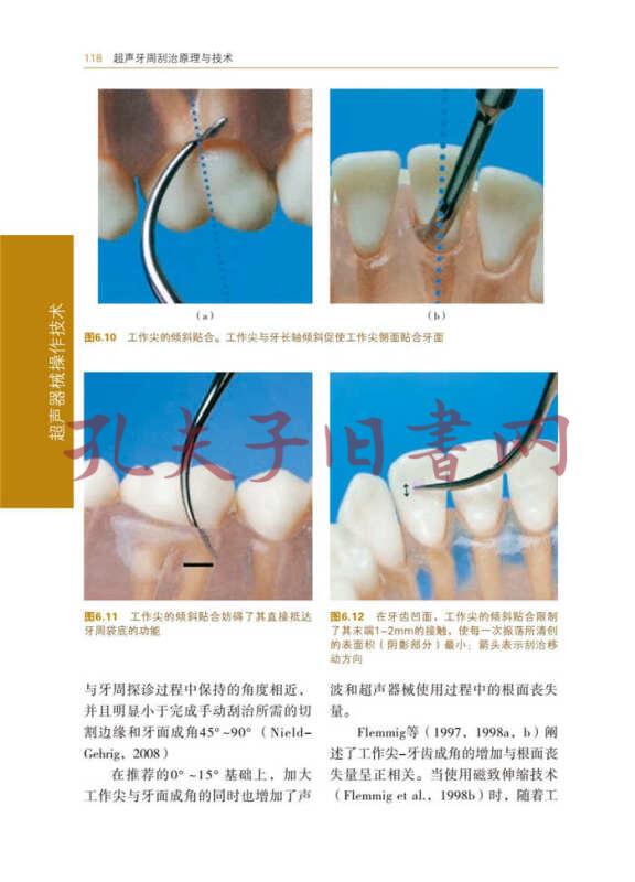 超声牙周刮治原理与技术