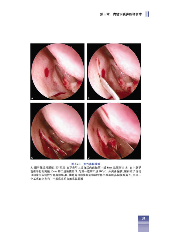 內鏡淚道手術彩色圖譜