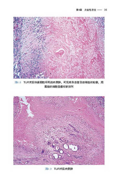 前列腺病理活检解读(第5版)