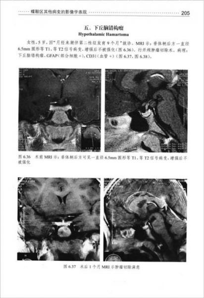 垂体腺瘤手术图谱