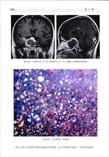 垂体腺瘤手术图谱
