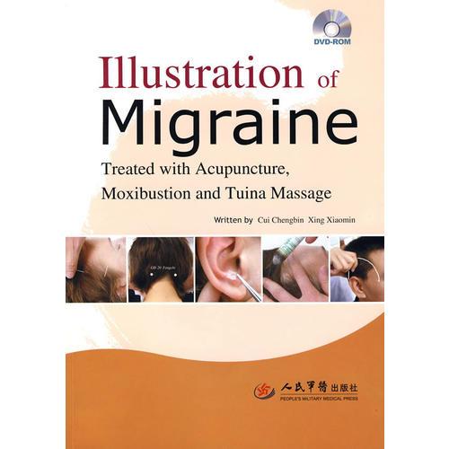 Illustration of Migraine（偏头痛针灸推拿治疗图解）（英文版）