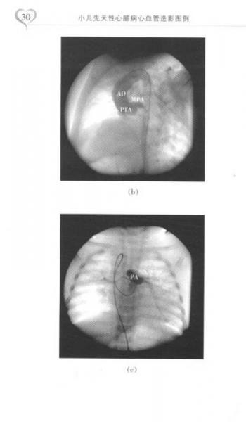 小儿先天性心脏病心血管造影图例