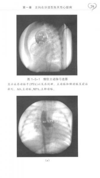 小儿先天性心脏病心血管造影图例