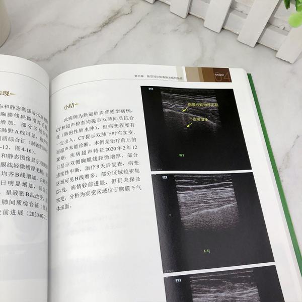 新型冠状病毒肺炎超声与CT对照图谱