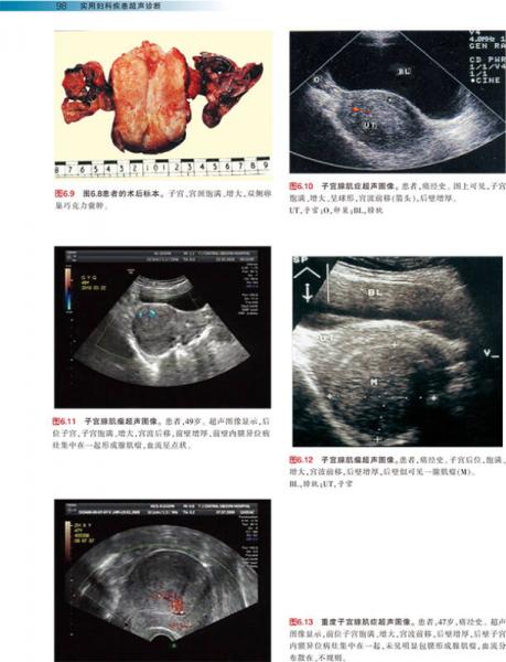 实用妇科疾患超声诊断