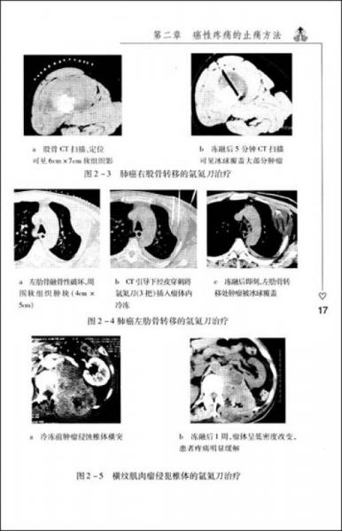 癌性疼痛的综合治疗