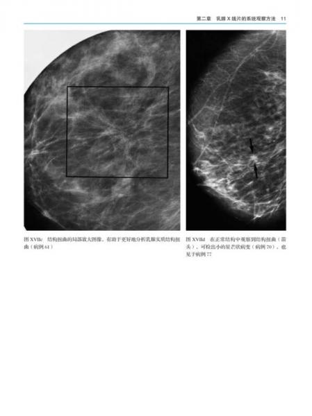 乳腺X线摄影教学图谱