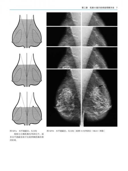 乳腺X线摄影教学图谱