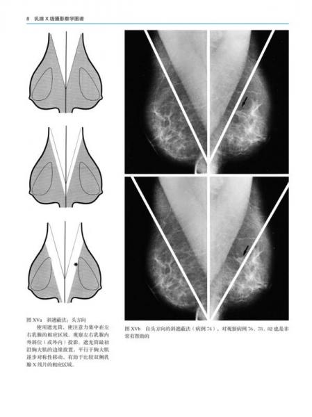 乳腺X线摄影教学图谱