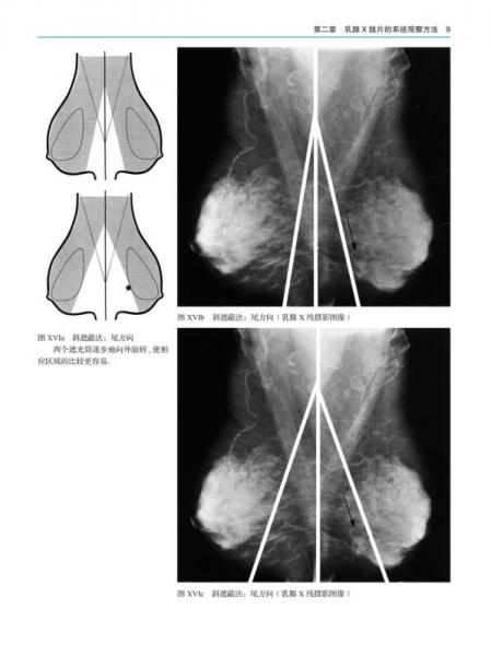 乳腺X线摄影教学图谱