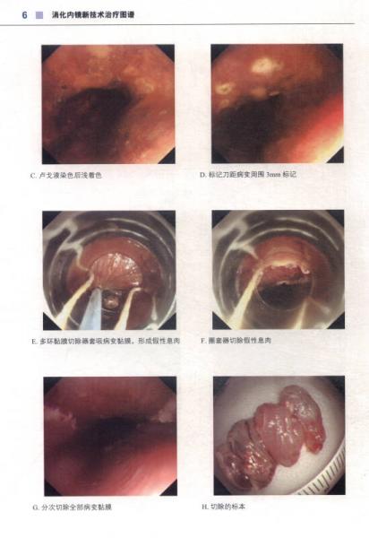 消化内镜新技术治疗图谱